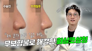 긴 화살코, 매부리 해결! 처진 코끝 올려주며 완성한 여성스러운 무보형물 코성형 11개월 차 케이스리뷰 (비중격 연골)