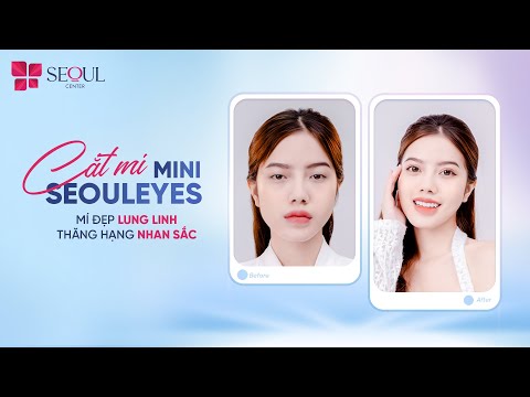 Sau 5 Tháng Cắt Mí Tại Seoul Center Khách Hàng Nói Gì?
