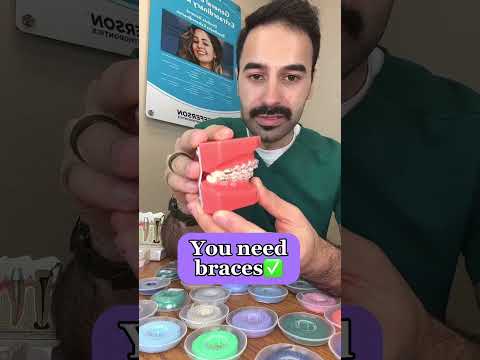 Signs you need braces🚨 #shorts