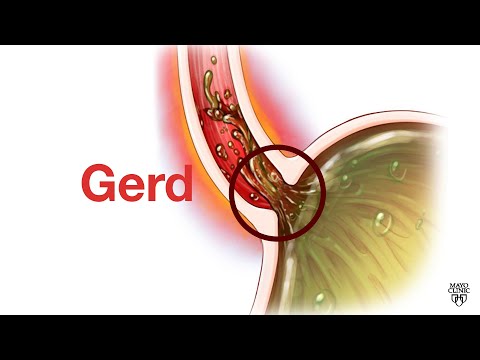 Mayo Clinic Minute - GERD is not 'just' heartburn