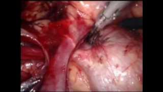 Pieloplastia con nefropexia laparoscópica. Laparoscopic Pyeloplasty - Miguel Angel Alonso Prieto