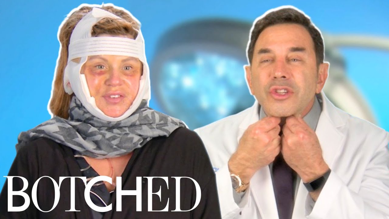 Dr. Nassif Fixes Lisa’s Facelift Gone Wrong FULL TRANSFORMATION | Botched | E!