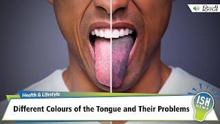 Different Colours of the Tongue and Their Problems