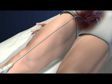 OptionELITE Retrievable Vena Cava Filter