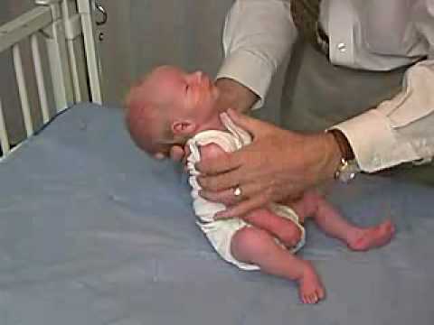 neurology exam: newborn-abnormal: Tone - Head Control