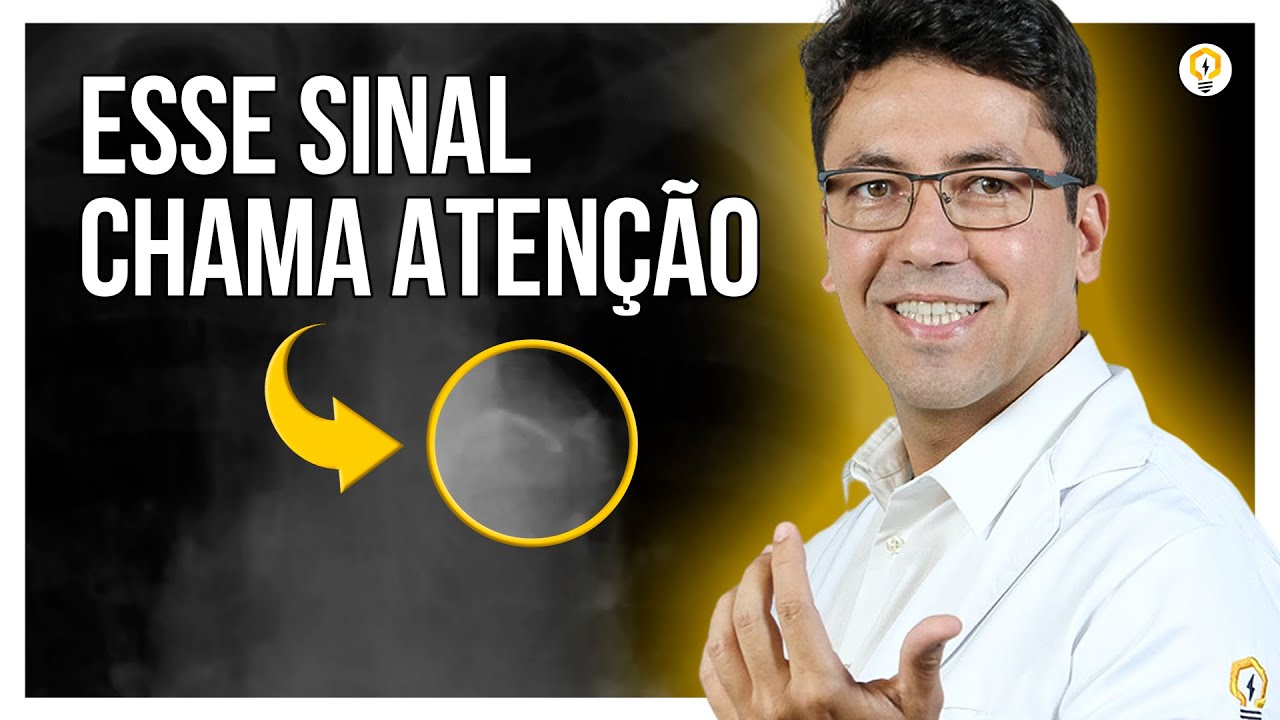 Sinal de DISSECÇÃO DE AORTA em RADIOGRAFIA de Tórax