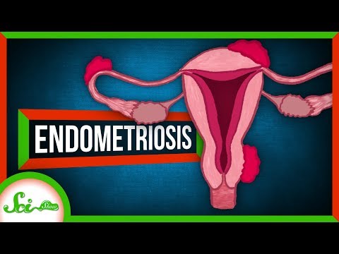 子宮内膜症。子宮組織が不正な動きをするとき (Endometriosis: When Uterine Tissue Goes Rogue)