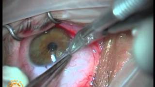 Sutursuz pterjium ameliyatı