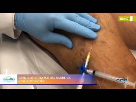 Varizes atingem 45% das mulheres; veja como evitar 22 04 2021