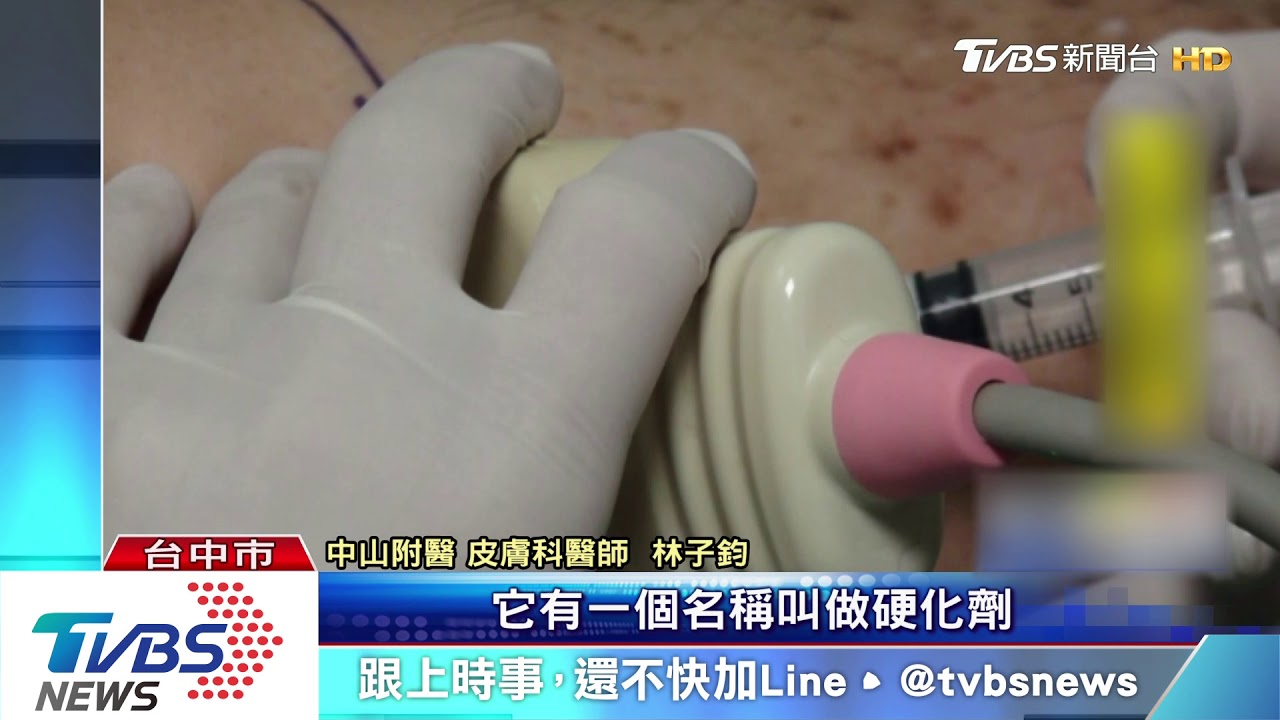 靜脈曲張變「蜂窩性組織炎」 醫打泡沫針治