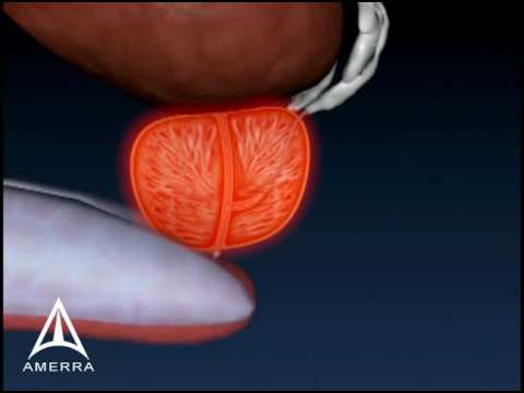 Prostate Biopsy - 3D Medical Animation