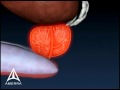 Prostate Biopsy 3D Medical Animation