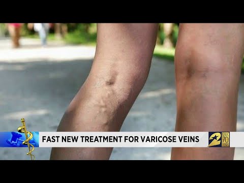licatorice cu vene varicoase