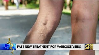 Fast new treatment for varicose veins