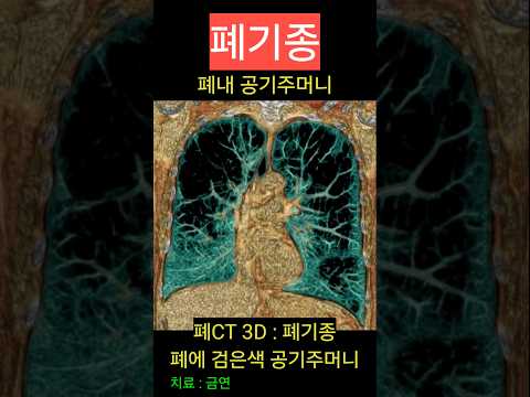 폐기종 CT 진단 치료는 금연