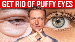 Get Rid of Puffy Eyes for Good with Dr. Berg