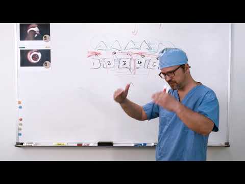 MIS TLIF Procedure | Post Surgery | Transforaminal Lumbar Interbody Fusion