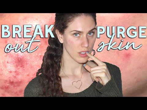 Skin Purge VS Breakouts - How To Tell If You're Having A Product Reaction
