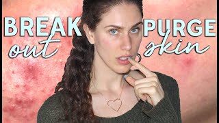 Skin Purge VS Breakouts - How To Tell If You