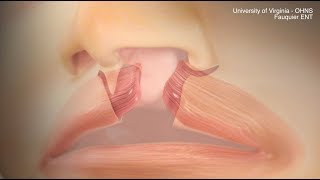 Cleft Lip Repair (Patient Version of Cleft Lip Surgery)