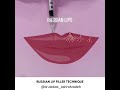 Russian Lip Filler Technique - Russian Lips Style Filler in Dubai #russianlip #lipfiller