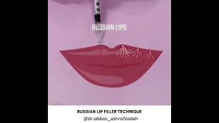 Russian Lip Filler Technique - Russian Lips Style Filler in Dubai #russianlip #lipfiller
