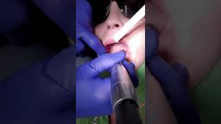 My Orthodontic Adventure 1 b) Interproximal Reduction 2