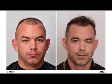 Patient "MIL" - FUE Hair Transplant onial