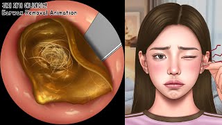 ASMR 면봉으로 귀 파면 위험한 이유! 꽉 막힌 왕귀지 제거하기 | 귀청소 | Deep & Stony Hard Earwax Removal | Ear Cleaning