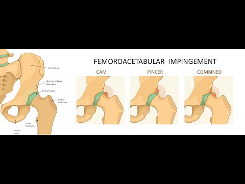 Video thumbnail: hip labral tears explained