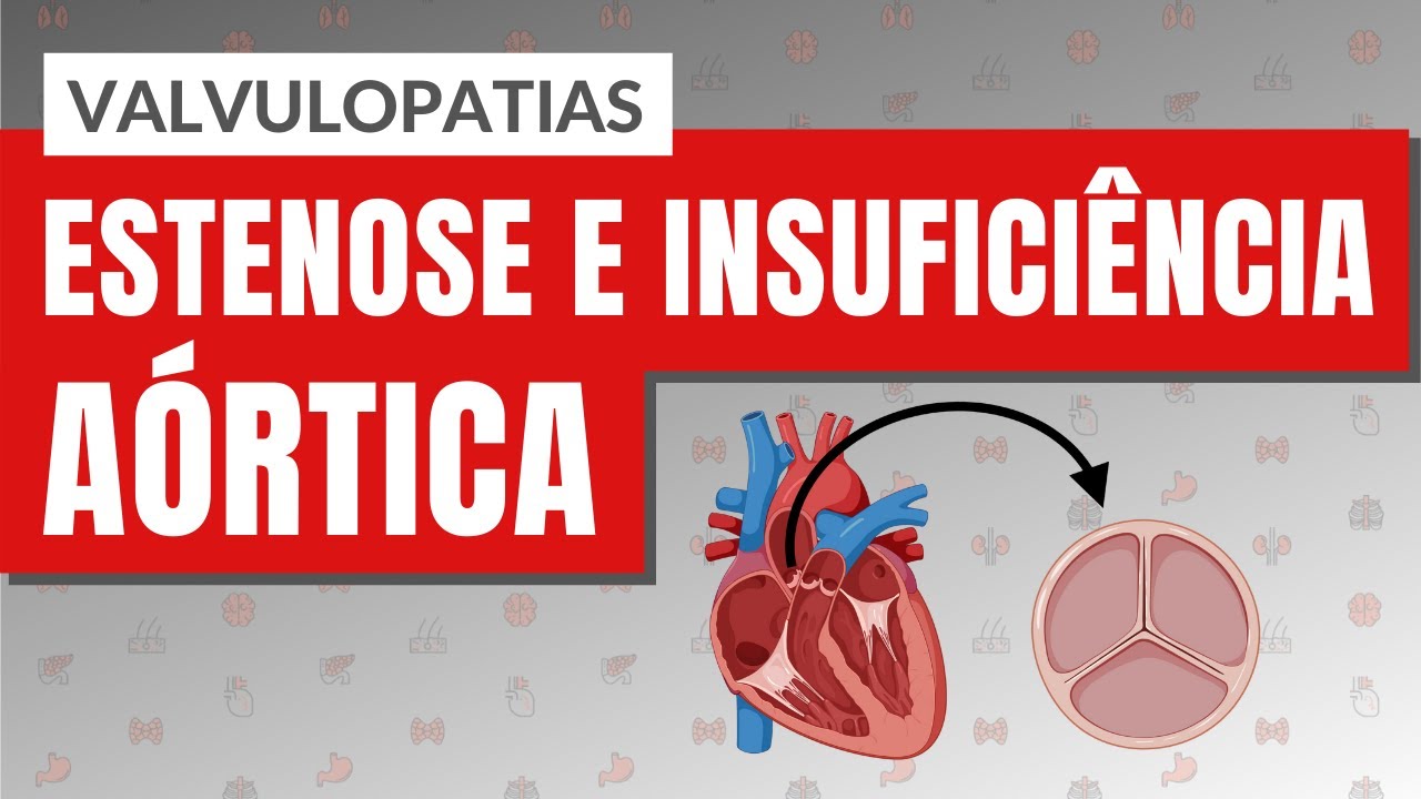 VALVULOPATIAS I PARTE 2: Estenose e Insuficiência aórtica