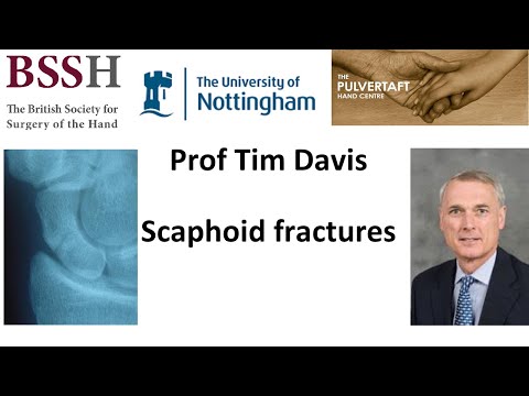 Scaphoid fractures by Prof Tim Davis