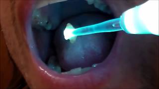 Worst Tonsil Stones, Popping Tonsils (HOT) X