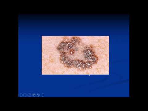 Melanoma Risk Factors and Prevention - Dr. Elaine McWhirter MD, MSc., FRCPC