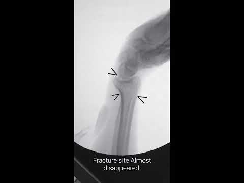 Smith's fracture | Closed reduction & plastering | Under C-arm imaging |Adamya Hospital videos