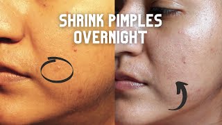 How to DRASTICALLY REDUCE YOUR PIMPLE SIZE OVER NIGHT | Vitacilina, Benzoyl Peroxide, Pimple Patches