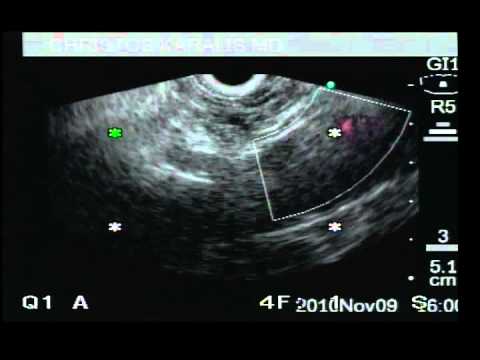 Pancreas Cancer - Celiac Plexus Neurolysis