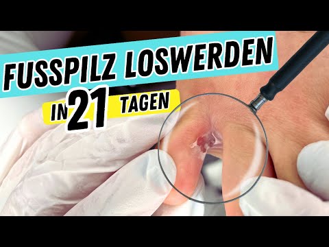 FUSSPILZ ENDLICH LOSWERDEN! | So behandelst du eine FUSSPILZINFEKTION schnell und effektiv!
