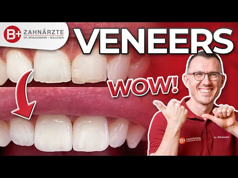 Frontzahn Veneers! Behandlung und Vorher-Nachher Vergleich: Alles erklärt am Patientenfall!