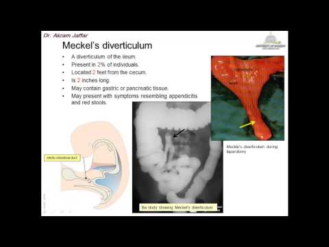 Embryologie des Anomalies Congénitales de l'Intestin Moyen