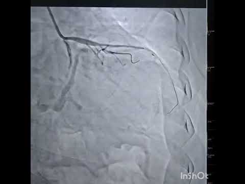 PCI to LAD Diag bifurcation provisional
