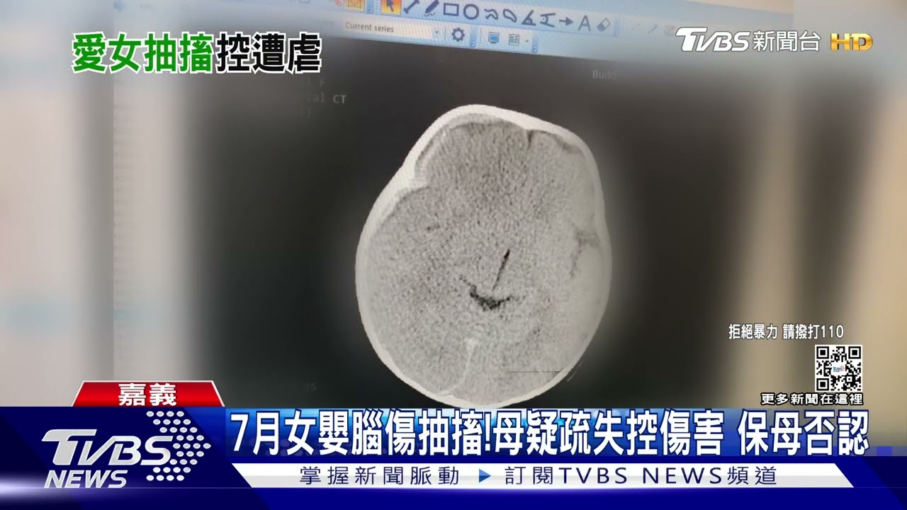 7月女嬰竟腦傷！母疑疏失搖晃控傷害　保母：照顧過程正常