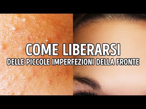 Bruciato nelle lentiggini di sole ha apparito Il pigmentary nota risposte linlayn