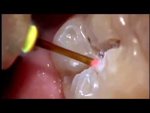 Tratamiento de caries sin dolor y sin anestesia (Láser dental)