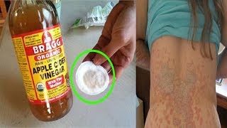 tinea versicolor treatment - how to get rid of tinea versicolor natural treatment