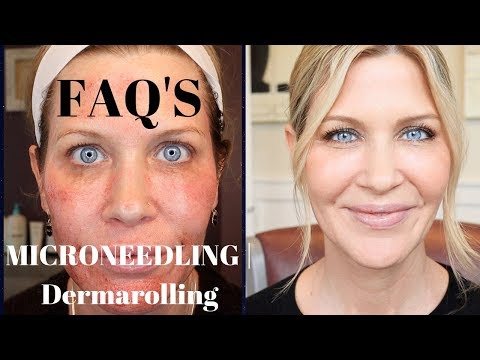 Microneedling | Dermarolling Q&A | Before, During and...