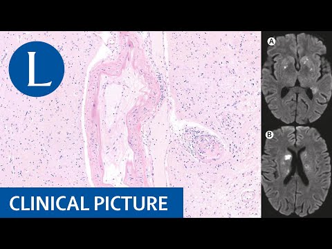 SLE and antiphospholipid syndrome: a difficult combination