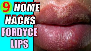 How to Get Rid of Fordyce Spots at Home Quickly | 9 Home Remedies for Fordyce Spots on Lips