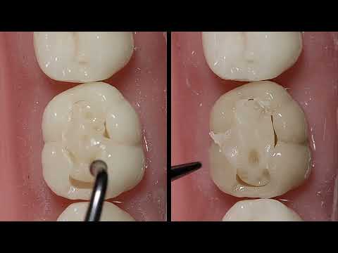 CLEARFIL MAJESTY ES-2 UNIVERSAL, шприц 3,6 г (Kuraray Noritake) - фото 3 - id-p2801454596