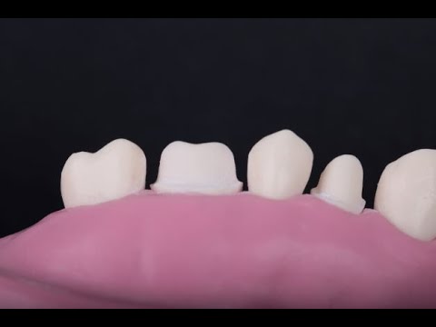 Molar-Full metal crown preparation